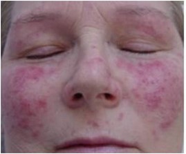 Rosacea prior to treatment with Fotona XP Spectro laser