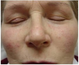 Rosacea following treatment with Fotona XP Spectro laser