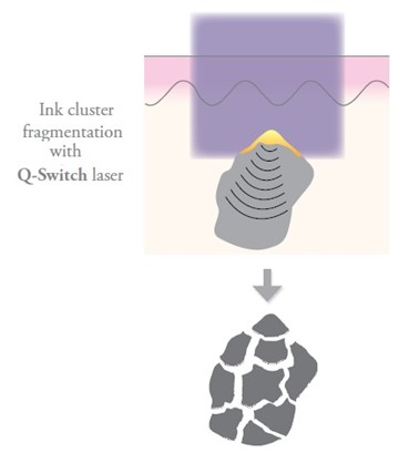Q-Switch fragmentation