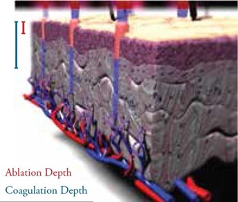 Optisim on the Quanta YouLaser